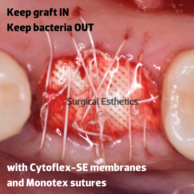 Cytoflex-SE PTFE Membrane | Surgical Esthetics | Surgical Esthetics Bone Graft